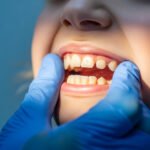 Teeth Whitening – What You Should Know