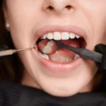 Root Canal Treatment or Extraction- The best solution for Your Smile